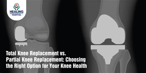 Total Knee Replacement Vs Partial Knee Replacement Choosing The Right Option For Your Knee Health