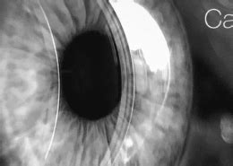 Cataract Surgery Lens Options Texas Eye Surgeons