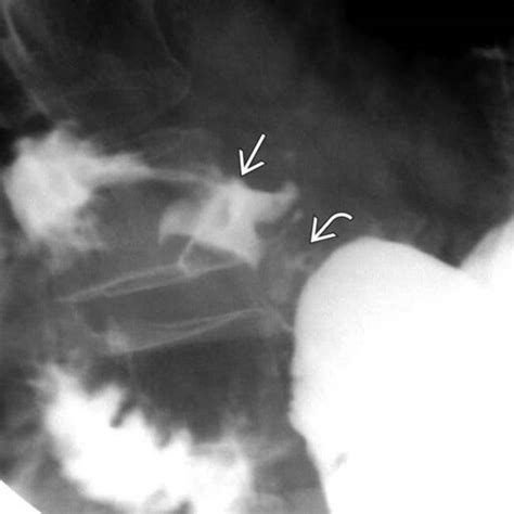 Upper Gi Series Ulcer