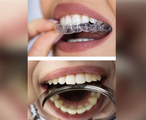 Retainers Orthodontic Aftercare Yorkshire Orthodontics