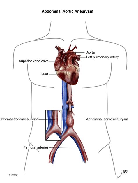 Abdominal Aortic Aneurysm Cardiovascular Medbullets Step 1