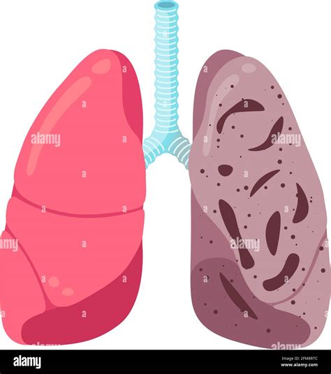 Unhealthy Lungs High Resolution Stock Photography And Images Alamy