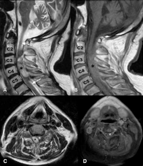 T2 A And T1 B Sagittal Magnetic Resonance Imaging Mri View On