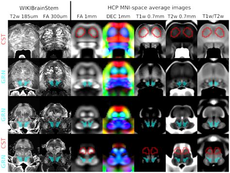 Mapping The Human Corticoreticular Pathway With Multimodal Delineation Of The Gigantocellular