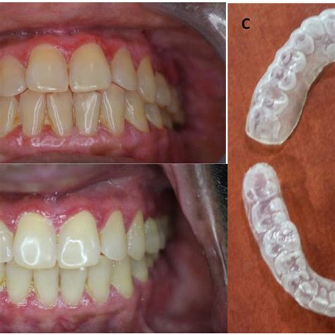 A Erythematous Soft Marginal Gingiva Showing Desquamation B Shows