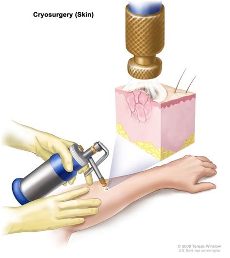 Definition of cryosurgery - NCI Dictionary of Cancer Terms - NCI