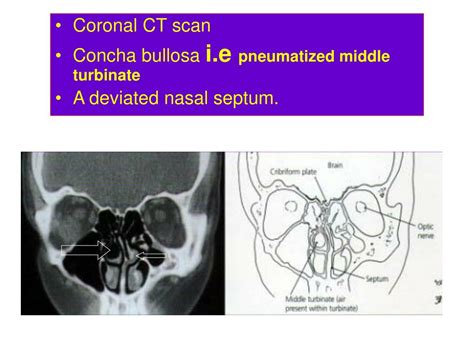 Ppt Radiology Of The Ear Powerpoint Presentation Free Download Id