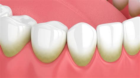 What Is Tartar Where Is It And How Does It Form Eastport Dental Az