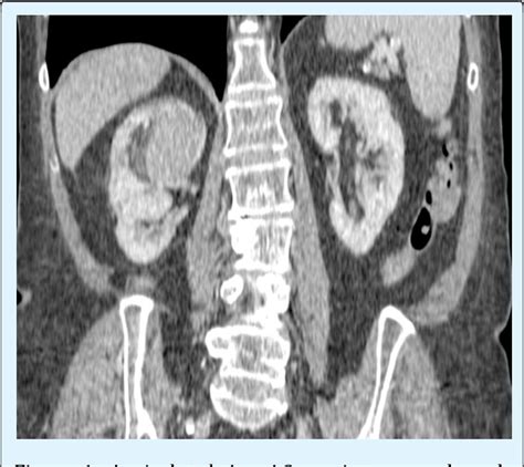 Figure From Isolated Renal Metastasis Mimicking Primary Renal Cell