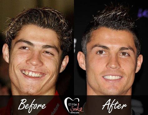 ( 23 pictures ) Celebrity Teeth: Before and After - Dental Pro