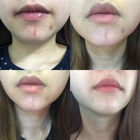 The Best Affordable Skin Laser Treatment In Kepong Kl Pj Kota Damansara