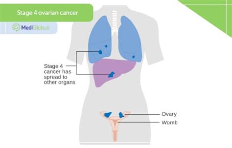 Ovarian cancer - is it curable at all stages? | Medical Tourism with ...