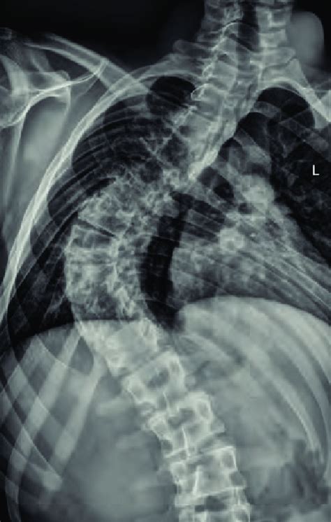 Scoliosis Is A Common Finding In Chiari Malformations Download Scientific Diagram