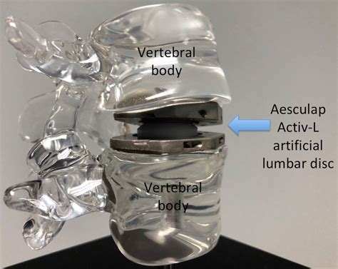 Artificial Disc Replacement (ADR) - Rocky Mountain Brain and Spine ...