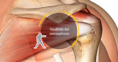 Sintomi Infiammazione Tendine Sovraspinato