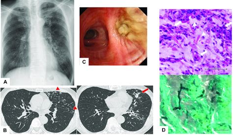 Chest Imaging And Bronchoscopic And Histological Findings At The Time