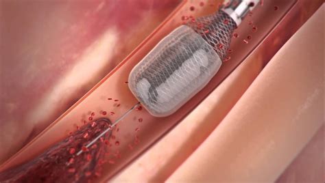 Capture MegaVac Mechanical Thrombectomy System Cholesterol