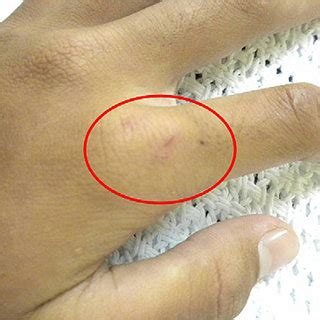 Superficial bite marks with minimal surrounding edema, most likely ...