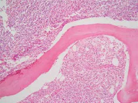 Immunohistochemistry Staining Cd3 Expression Of The Leukemic Cells Download Scientific Diagram