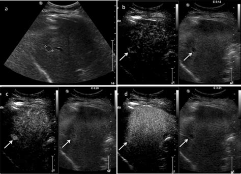 Ceus Li Rads A Pictorial Review Abstract Europe Pmc