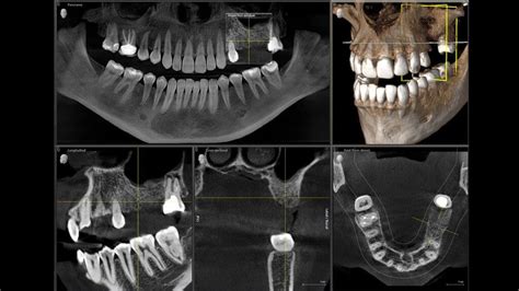 Cbct Cone Beam Computer Tomography Molnar Dental