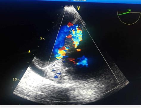 Tee Revealing A Large Tricuspid Valve Vegetation And A Perforated Download Scientific Diagram