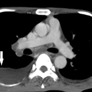 Primary Tuberculosis Axial Contrast Enhanced Computed Tomography