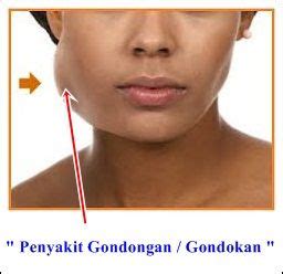 Obat Gondongan Tradisional | Incoming call screenshot, Incoming call