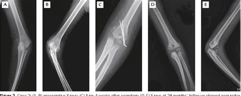 Lateral Condyle Epicondyle