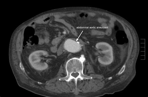 Abdominal Aortic Aneurysm