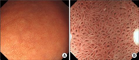 A Esophagogastroduodenoscopy Reveals Diffuse Sesame Like Dark Brown Download Scientific