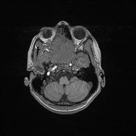 Juvenile Nasopharyngeal Angiofibroma Image Radiopaedia Org