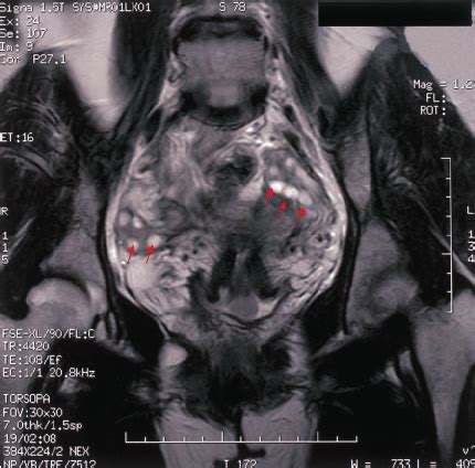 MRI of polycystic ovaries (arrows) in a 37- year-old woman. | Download ...