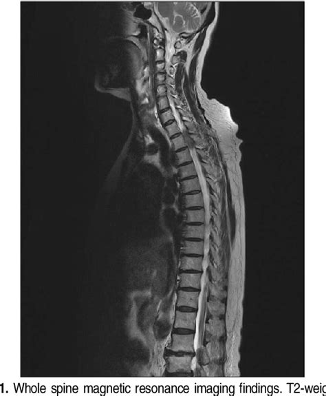 Figure From Neurologic Complication Following Spinal Epidural