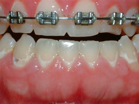 Decay After Orthodontics Woodbridge Ontario Dr Frank Procopio