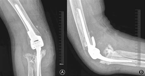 The Xray Of Elbow Joint Of Case At Months After Operation Showing