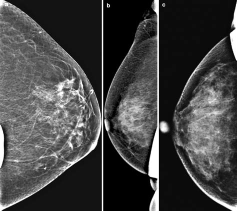 Artifacts And Pitfalls In Breast Imaging Radiology Key