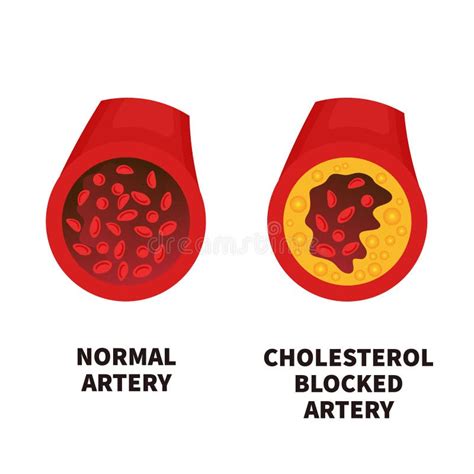 Normal And Narrowed Artery Cross Section Illustration Stock