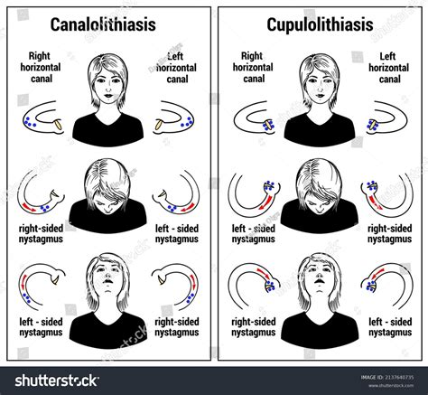 Visual Aid Benign Paroxysmal Positional Vertigo Stock Vector Royalty