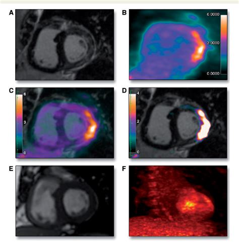 Figure From Multimodality Imaging In Restrictive Cardiomyopathies An