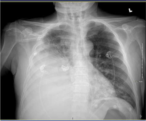 Chest X‐ray Bilateral Pneumonia And Large Right Pleural Effusion Download Scientific Diagram