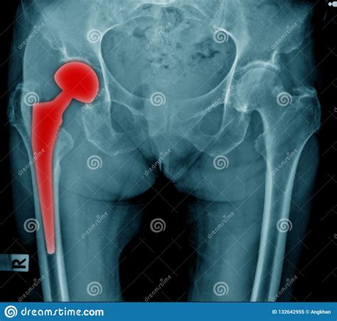 Hip Replacement X-ray Image Stock Image - Image of change, osteoporosis ...