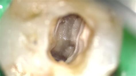 Tip To Find Mv Canal Pop Dentistry