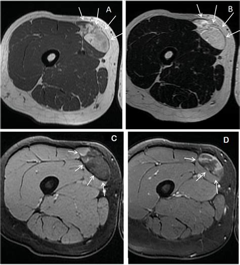 Ultrasound Showing A Hyperechoic Tissue Mass With Hypoechoic Areas And Download Scientific