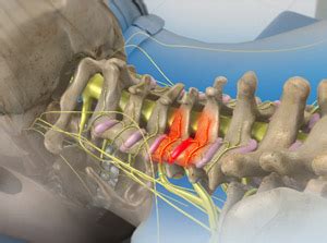 Medial Branch Block Cervical Seaside Spine And Pain Center