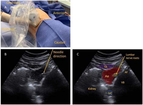 Ultrasound Guided Lumbar Plexus Blocks In Paediatric Patients Wfsa