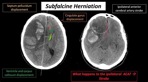 Low Pressure Headache Mri Findings - Headache