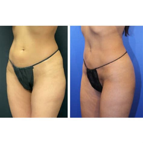 Liposuction Gallery Dr Jeffrey Lisiecki