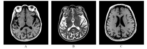 Brain Mri A T1 Weighted Image Of Basal Ganglia Bg And Striatum Old Download Scientific