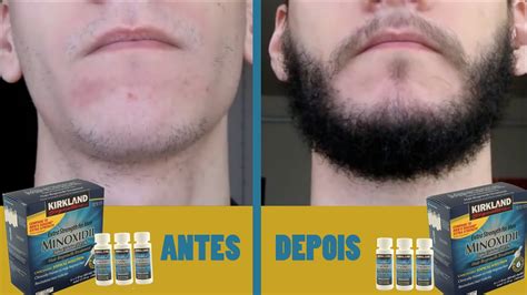 Evolu O Do Tratamento Meses Antes E Depois Minoxidil Kirkland